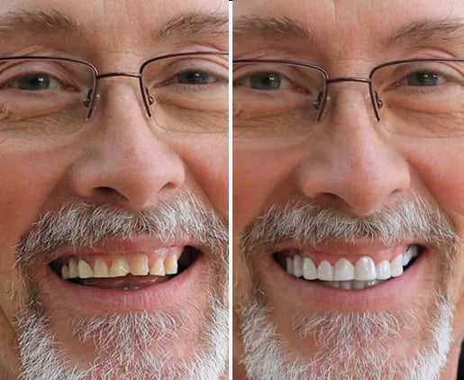 SnapBright™ Snap-On Veneers