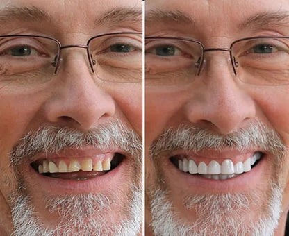 SnapBright™ Snap-On Veneers