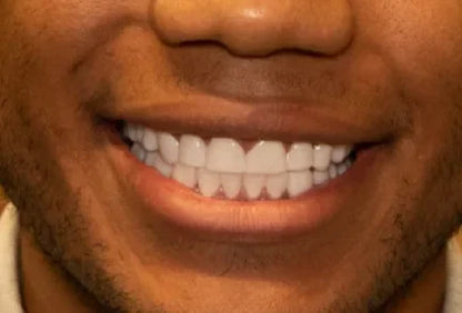 SnapBright™ Snap-On Veneers